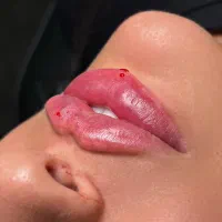 آموزش حرفه ای تزریق فیلر(ژل)،لب روسی،لیفت بانخ