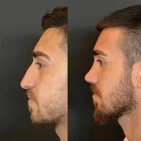 دیگه ژیلت نزن واسه در آوردنش