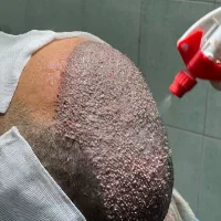کاشت مو و ابرو فوق حرفه ای شیراز و تهران
