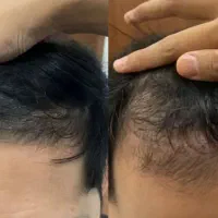 رویش مجدد مو و *قطع ریزش*