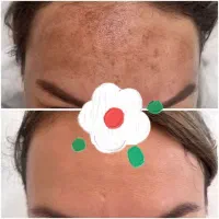 حلزون‌تراپی