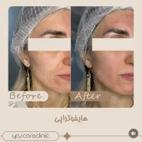 تنها کلینیک تخصصی هایفوتراپی درمانی کشور هایفو|خدمات آرایشگری و زیبایی|تبریز, |دیوار