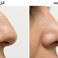 تغییر فرم بینی بدون جراحی قبل و بعد