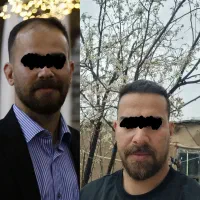کاشت مو|خدمات آرایشگری و زیبایی|سیرجان, |دیوار