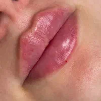 آف ویژه خدمات ژل و بوتاکس