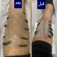 زالو درمانی